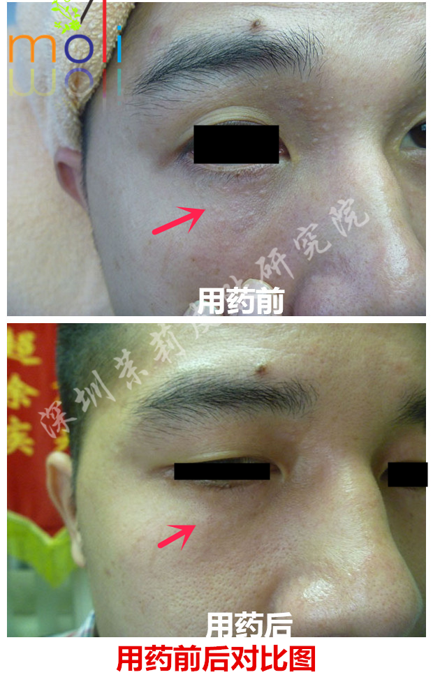 智能分子疗法治疗眼部汗管瘤的前后变化