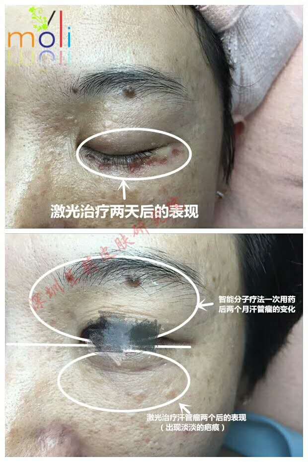 汗管瘤