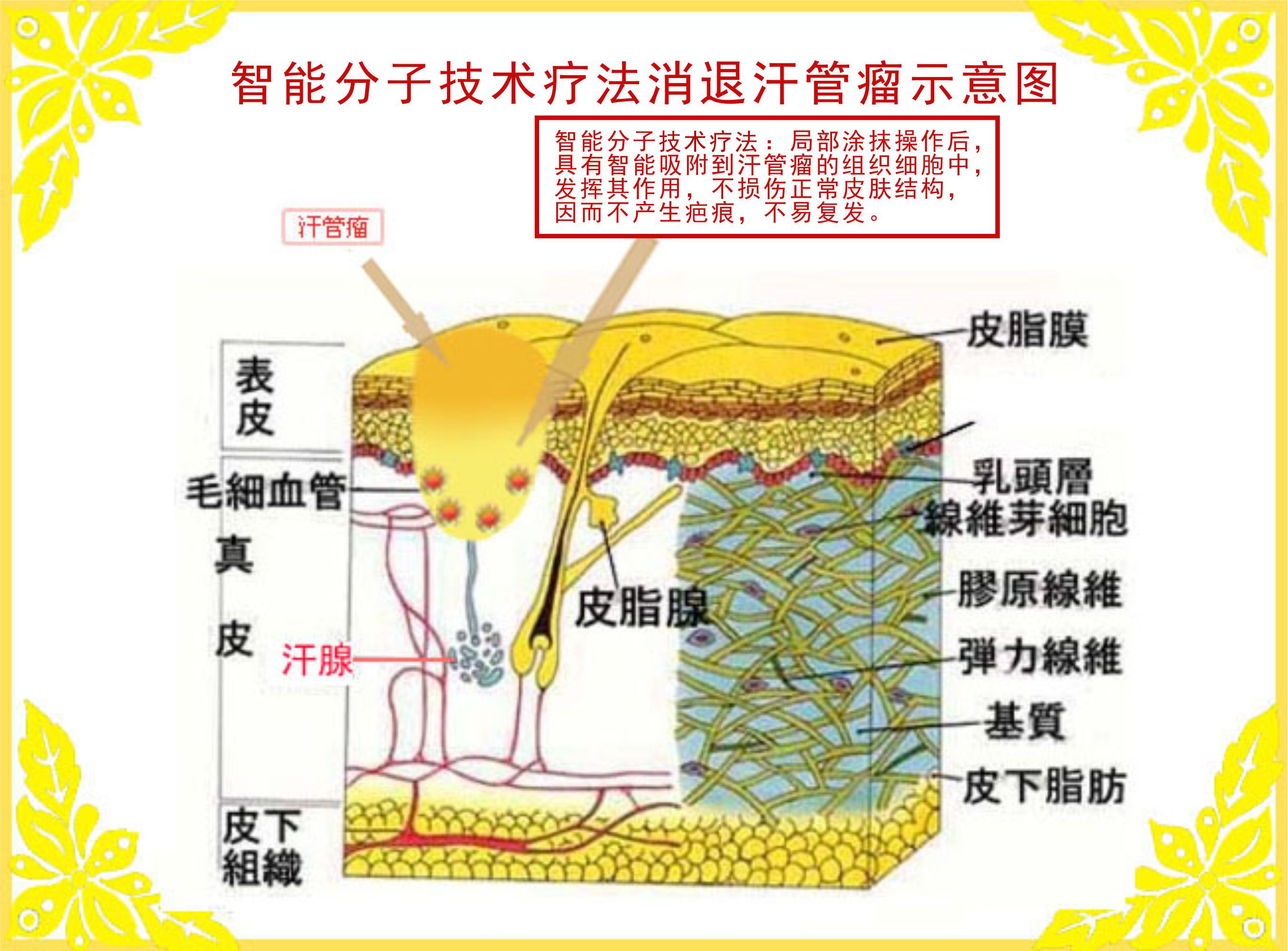 眼部汗管瘤(图1) 眼部汗管瘤(图1)