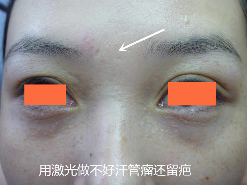 汗管瘤