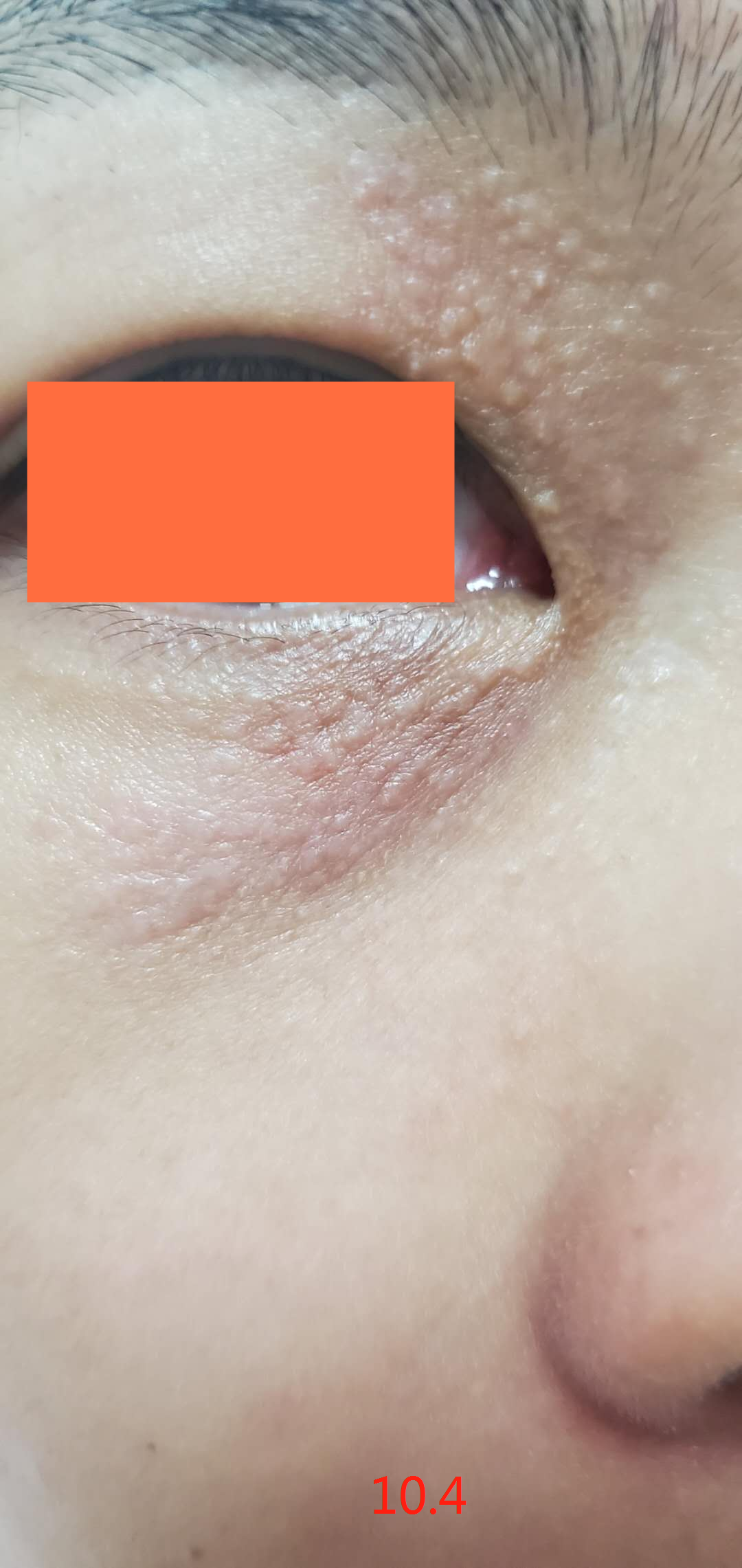 记录汗管瘤三个月的消退变化，每隔一个月变一样(图3)