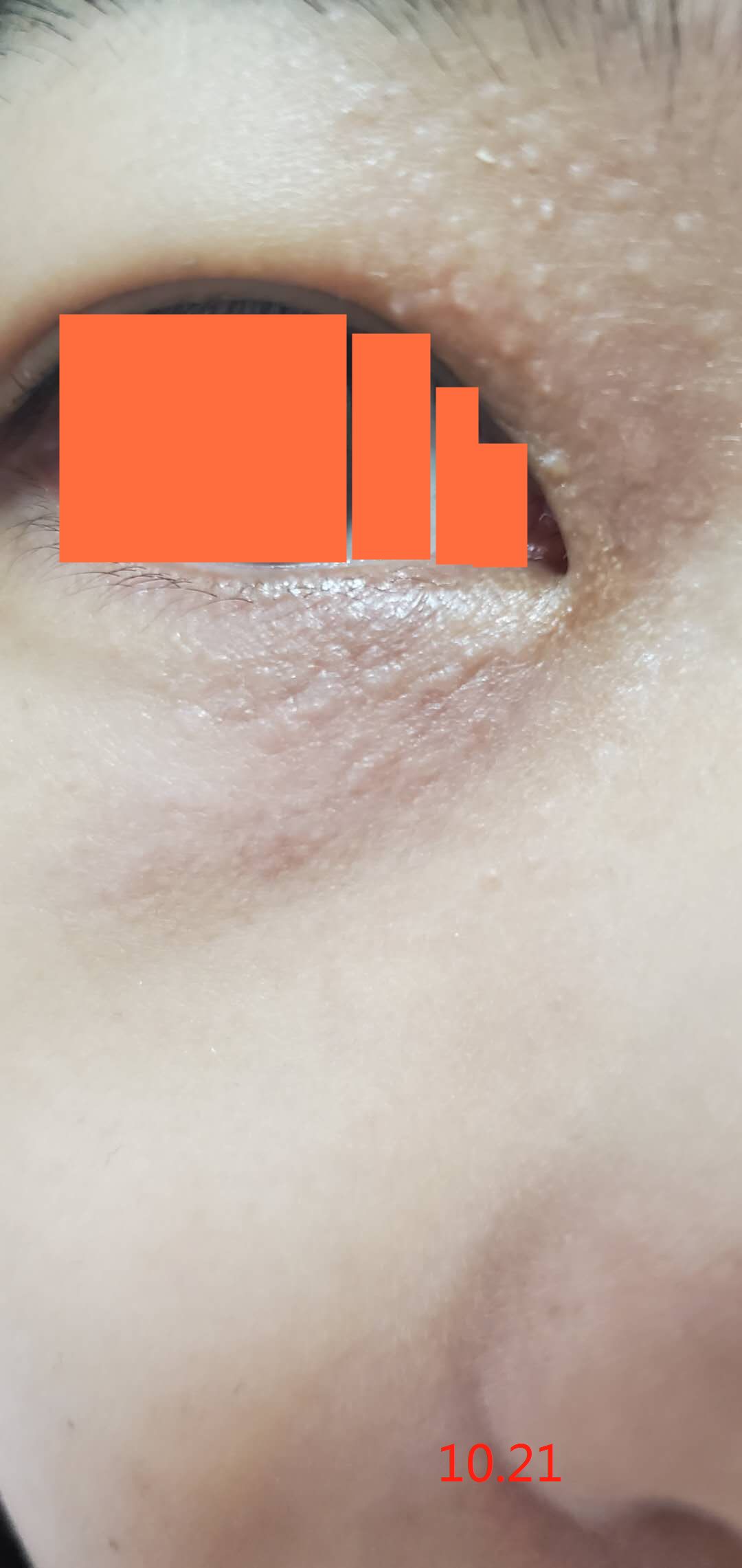 汗管瘤