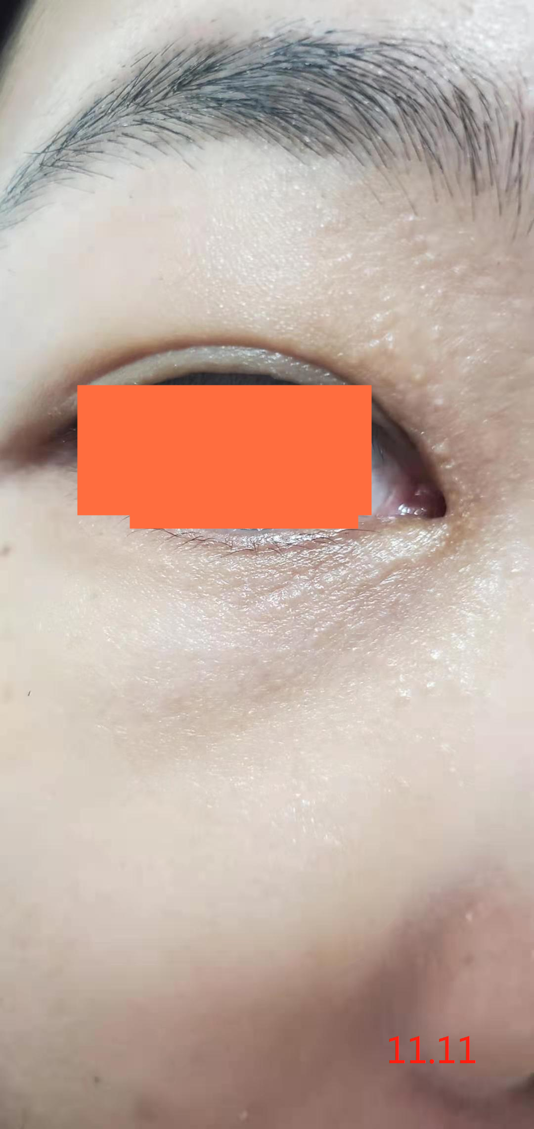 汗管瘤