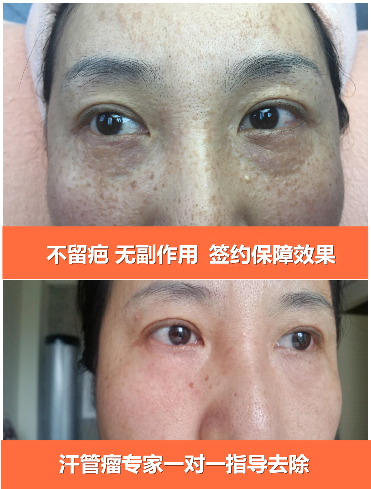 汗管瘤